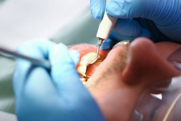 Best Urgent Care for Lost Fillings or Crowns in Jupiter, FL
